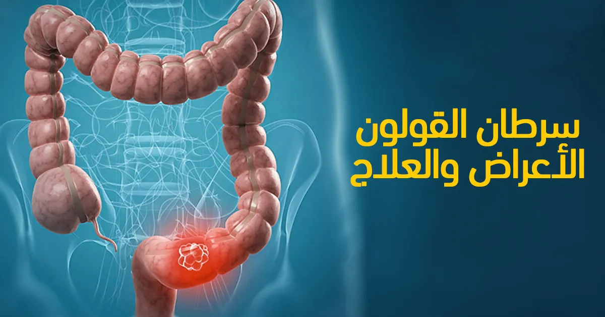 سرطان القولون : الأعراض والعلاج